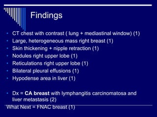 • CT chest with contrast ( lung + mediastinal window) (1)
• Large, heterogeneous mass right breast (1)
• Skin thickening + nipple retraction (1)
• Nodules right upper lobe (1)
• Reticulations right upper lobe (1)
• Bilateral pleural effusions (1)
• Hypodense area in liver (1)
• Dx = CA breast with lymphangitis carcinomatosa and
liver metastasis (2)
What Next = FNAC breast (1)
Findings
 