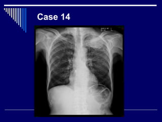 Case 14
 