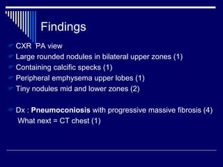  CXR PA view
 Large rounded nodules in bilateral upper zones (1)
 Containing calcific specks (1)
 Peripheral emphysema upper lobes (1)
 Tiny nodules mid and lower zones (2)
 Dx : Pneumoconiosis with progressive massive fibrosis (4)
What next = CT chest (1)
Findings
 