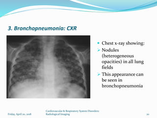 Heterogeneous Opacity Radiology chs 3101 cardiovascular and respiratory system disorders | PPTX