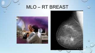 26
MLO – RT BREAST
 
