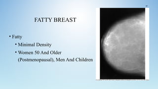 FATTY BREAST
• Fatty
• Minimal Density
• Women 50 And Older
(Postmenopausal), Men And Children
37
 