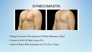 GYNECOMASTIA
• Benign Excessive Development Of Male Mammary Gland
• Occurs In 40% Of Male Cancer Pt’s
• Survival Rates With Treatment Are 97% For 5 Years
39
 