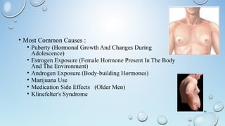 • Most Common Causes :
• Puberty (Hormonal Growth And Changes During
Adolescence)
• Estrogen Exposure (Female Hormone Present In The Body
And The Environment)
• Androgen Exposure (Body-building Hormones)
• Marijuana Use
• Medication Side Effects (Older Men)
• Klinefelter's Syndrome
40
 