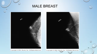 MALE BREAST
43
 