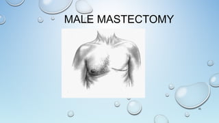 MALE MASTECTOMY
45
 