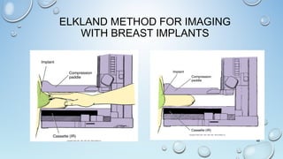 ELKLAND METHOD FOR IMAGING
WITH BREAST IMPLANTS
48
 