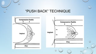 “PUSH BACK” TECHNIQUE
50
 