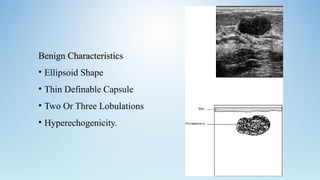 Benign CharacteristicsBenign Characteristics
• Ellipsoid Shape
• Thin Definable Capsule
• Two Or Three Lobulations
• Hyperechogenicity.
 