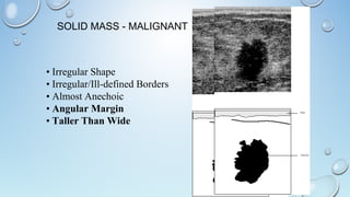 SOLID MASS - MALIGNANT
• Irregular Shape
• Irregular/Ill-defined Borders
• Almost Anechoic
• Angular Margin
• Taller Than Wide
 