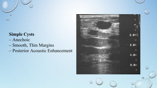 69
Simple Cysts
– Anechoic
– Smooth, Thin Margins
– Posterior Acoustic Enhancement
 