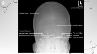 Radiological Imaging in Head and Neck and relevant anatomy