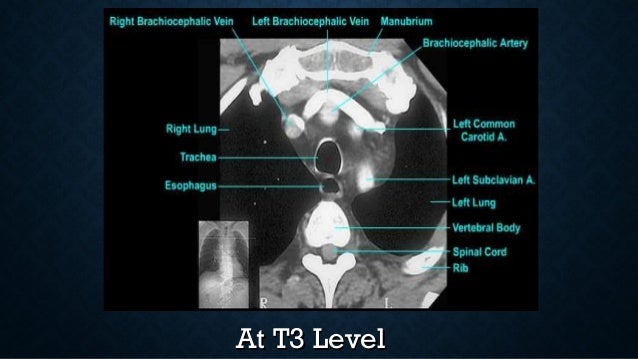 Radiology day 3 mediastinal anatomy