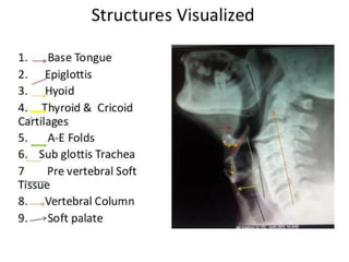Preauricular Rhytids Radiology ENT.pdf