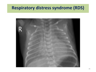 Neonatal Rds Radiology Radiology in newborn collected by Dr. Saiful islam MD | PPT