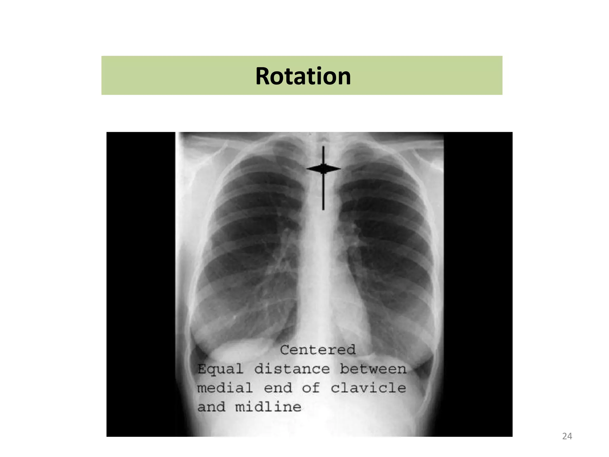 common neonatal Radiology findings | PPT