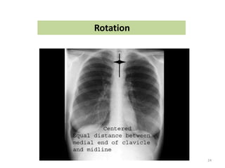 common neonatal Radiology findings | PPT