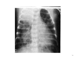 common neonatal Radiology findings | PPT