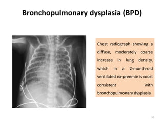common neonatal Radiology findings | PPT