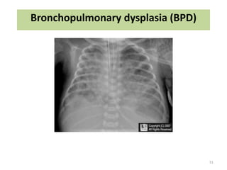common neonatal Radiology findings | PPT