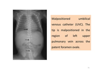 Uvc Course Radiology common neonatal Radiology findings | PPT