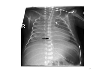 common neonatal Radiology findings | PPT