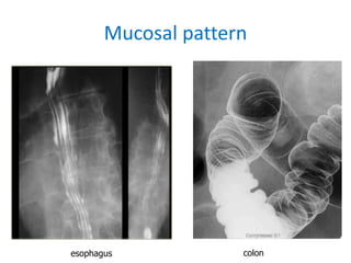 Mucosal Pattern Radiology GIT.ppt