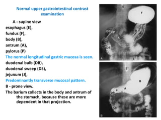 Normal Antrum Visual Radiology GIT.ppt