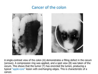 Radiology GIT.ppt