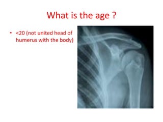 What is the age ?
• <20 (not united head of
humerus with the body)
 