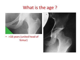 What is the age ?
• >18 years (united head of
femur)
 