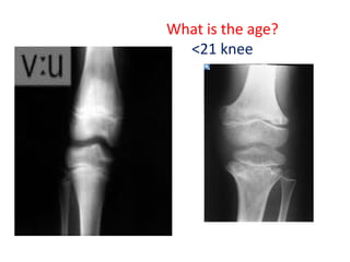 What is the age?
<21 knee
 