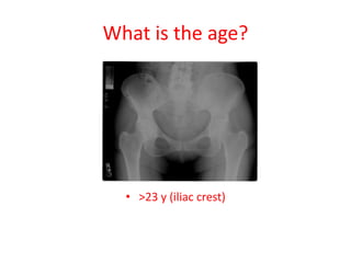 What is the age?
• >23 y (iliac crest)
 