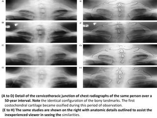 (A to D) Detail of the cervicothoracic junction of chest radiographs of the same person over a
50-year interval. Note the identical configuration of the bony landmarks. The first
costochondral cartilage became ossified during this period of observation.
(E to H) The same studies are shown on the right with anatomic details outlined to assist the
inexperienced viewer in seeing the similarities.
 