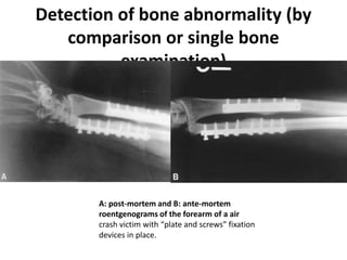 Detection of bone abnormality (by
comparison or single bone
examination)
Iatrogenic Interference
• Doctors and dentists leave their indisputable
markers in some bodies and they are a
godsend for identification purposes.
A: post-mortem and B: ante-mortem
roentgenograms of the forearm of a air
crash victim with “plate and screws” fixation
devices in place.
 
