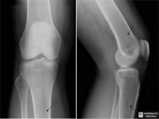 Detection of bone abnormality (by
comparison or single bone
examination)
Harris’s lines
• Growth Arrest/Recovery Lines. Transverse dense lines
(black arrows) perpendicular to the long axis
of the bone in the metaphysis and migrate towards the
diaphysis with growth may indicate
a previous prolonged illness or debilitating state.
• Disappear after correction of the cause , so comparison
with previous x ray film must be close in time of
examination
 