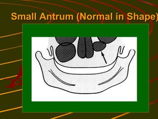 Normal Antrum Visual Radiology in maxillofacial_imaging | PPT