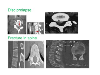 Disc prolapse
Fracture in spine
 