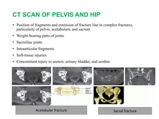 CT SCAN OF PELVIS AND HIP
• Position of fragments and extension of fracture line in complex fractures,
particularly of pelvis, acetabulum, and sacrum
• Weight-bearing parts of joints
• Sacroiliac joints
• Intraarticular fragments
• Soft-tissue injuries
• Concomitant injury to ureters, urinary bladder, and urethra
Acetabular fracture Sacral fracture
 