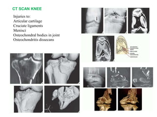CT SCAN KNEE
Injuries to:
Articular cartilage
Cruciate ligaments
Menisci
Osteochondral bodies in joint
Osteochondritis dissecans
 