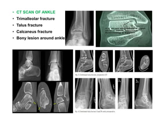 • CT SCAN OF ANKLEnd fracture
• Trimalleolar fracture
• Talus fracture
• Calcaneus fracture
• Bony lesion around ankle
 