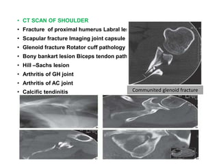 • CT SCAN OF SHOULDERArthrography
• Fracture of proximal humerus Labral lesion
• Scapular fracture Imaging joint capsule
• Glenoid fracture Rotator cuff pathology
• Bony bankart lesion Biceps tendon pathology
• Hill –Sachs lesion
• Arthritis of GH joint
• Arthritis of AC joint
• Calcific tendinitis Communited glenoid fracture
 