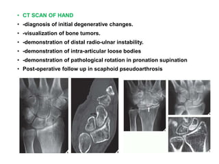 • CT SCAN OF HANDpal.
• -diagnosis of initial degenerative changes.
• -visualization of bone tumors.
• -demonstration of distal radio-ulnar instability.
• -demonstration of intra-articular loose bodies
• -demonstration of pathological rotation in pronation supination
• Post-operative follow up in scaphoid pseudoarthrosis
 
