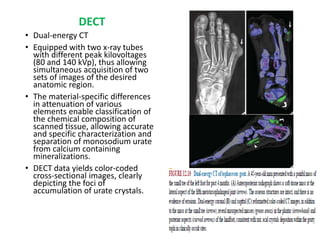 DECT
• Dual-energy CT
• Equipped with two x-ray tubes
with different peak kilovoltages
(80 and 140 kVp), thus allowing
simultaneous acquisition of two
sets of images of the desired
anatomic region.
• The material-specific differences
in attenuation of various
elements enable classification of
the chemical composition of
scanned tissue, allowing accurate
and specific characterization and
separation of monosodium urate
from calcium containing
mineralizations.
• DECT data yields color-coded
cross-sectional images, clearly
depicting the foci of
accumulation of urate crystals.
 