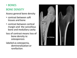 • BONES
BONE DENSITY
Assess general bone density
• contrast between soft
tissues and bone
• contrast between cortical
margin and the cancellous
bone and medullary cavity
loss of contrast means loss of
bone density ie:
osteoporosis
labeled as osteopenia,
demineralization or
rarefaction.
 