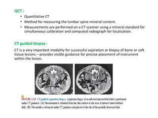 QCT :
• Quantitative CT
• Method for measuring the lumbar spine mineral content.
• Measurements are performed on a CT scanner using a mineral standard for
simultaneous calibration and computed radiograph for localization.
CT guided biopsy :
CT is a very important modality for successful aspiration or biopsy of bone or soft
tissue lesions – provides visible guidance for precise placement of instrument
within the lesion.
 
