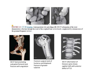 3D CT demonstrating
subcapital femoral neck
fracture with angulation
Fracture surgical neck of
humerus and displaced
fracture of greater
tubercle
3D CT reformation of
thoracic spine shows
sagittal cleft with anterior
defect of T11
 