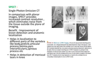 SPECT :
Single Photon Emission CT
In comparison with planar
images, SPECT provides
increased contrast resolution ,
which eliminates noise from
the tissue outside the plane of
imaging.
Benefit : Improvement of
lesion detection and anatomic
localization
• Helps in localization to
different parts of the vertebra
like body,pedicle,articular
process,lamina,pars
interarticularis,spinous
process etc
• Helps in detection of meniscal
tears in knee
 