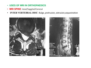 • USES OF MRI IN ORTHOPAEDICS
• MRI SPINE: Axial/Saggital/Coronal
• INTER VERTEBRAL DISC: Bulge, protrusion, extrusion,sequestration
 