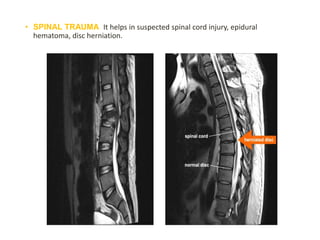 • SPINAL TRAUMA: It helps in suspected spinal cord injury, epidural
hematoma, disc herniation.
 